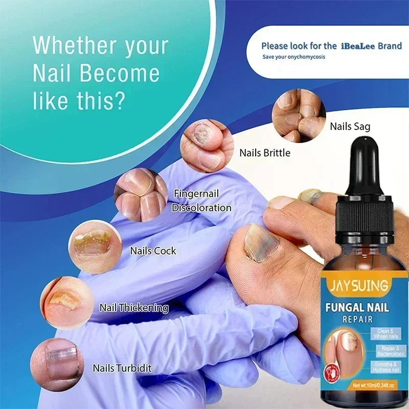 1/2/4/5PCS Nail Fungal Treatment Feet Care Essence Repair Nail Fungus Removal Serum Gel Anti Infection Paronychia Onychomycosis