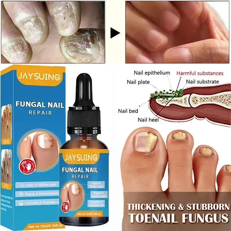 1/2/4/5PCS Nail Fungal Treatment Feet Care Essence Repair Nail Fungus Removal Serum Gel Anti Infection Paronychia Onychomycosis