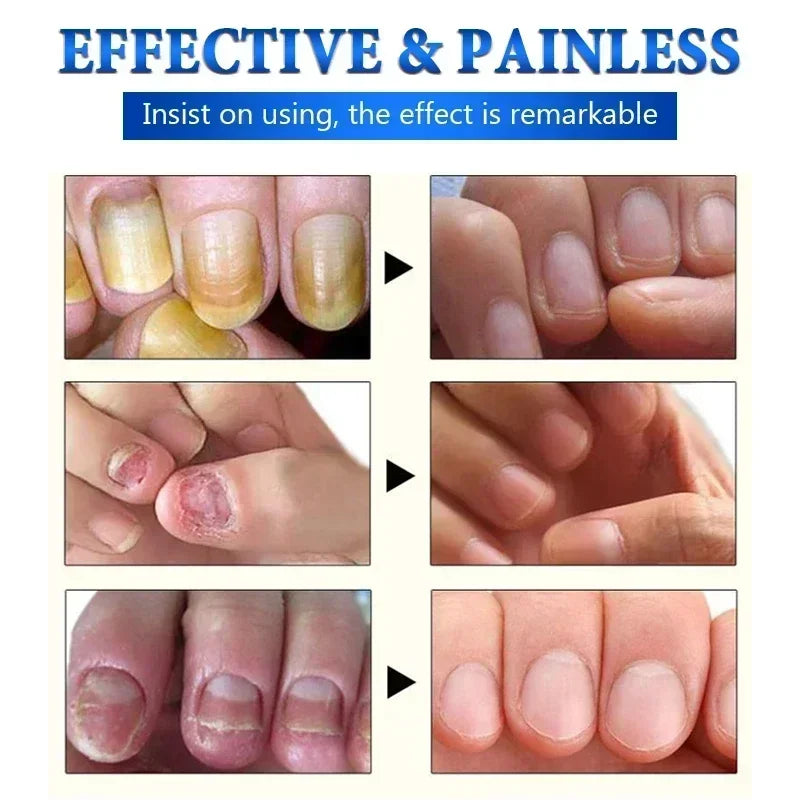 1/2/4/5PCS Nail Fungal Treatment Feet Care Essence Repair Nail Fungus Removal Serum Gel Anti Infection Paronychia Onychomycosis