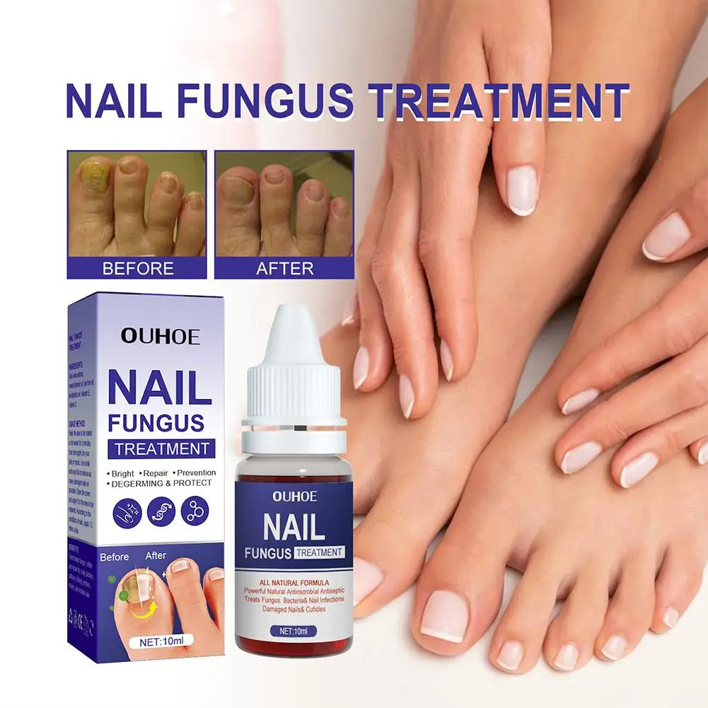 1PCS Nail Fungal Treatment Feet Care Essence Anti Infection Fungal Repair Onychomycosis Nail Fungus Serum Paronychia Remova B9J4